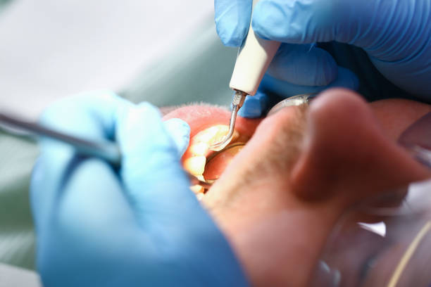 Best Dentist for Tooth Abscess  in Rock Springs, NM